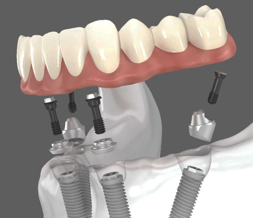 All-on-4 Implants