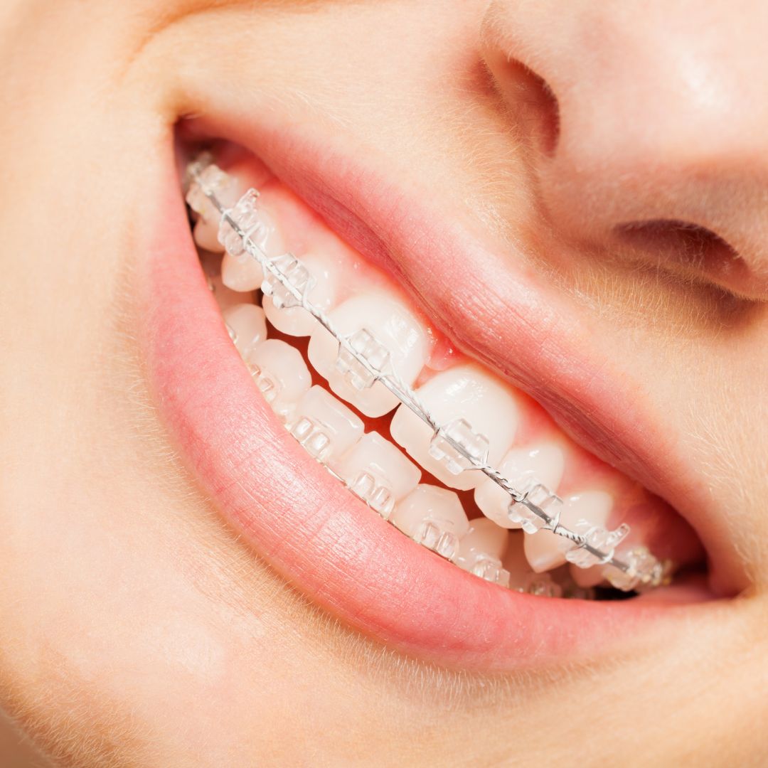 Ceramic Braces