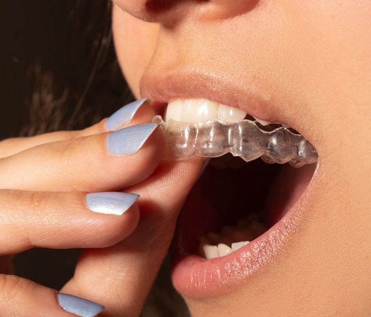 Clear Aligners