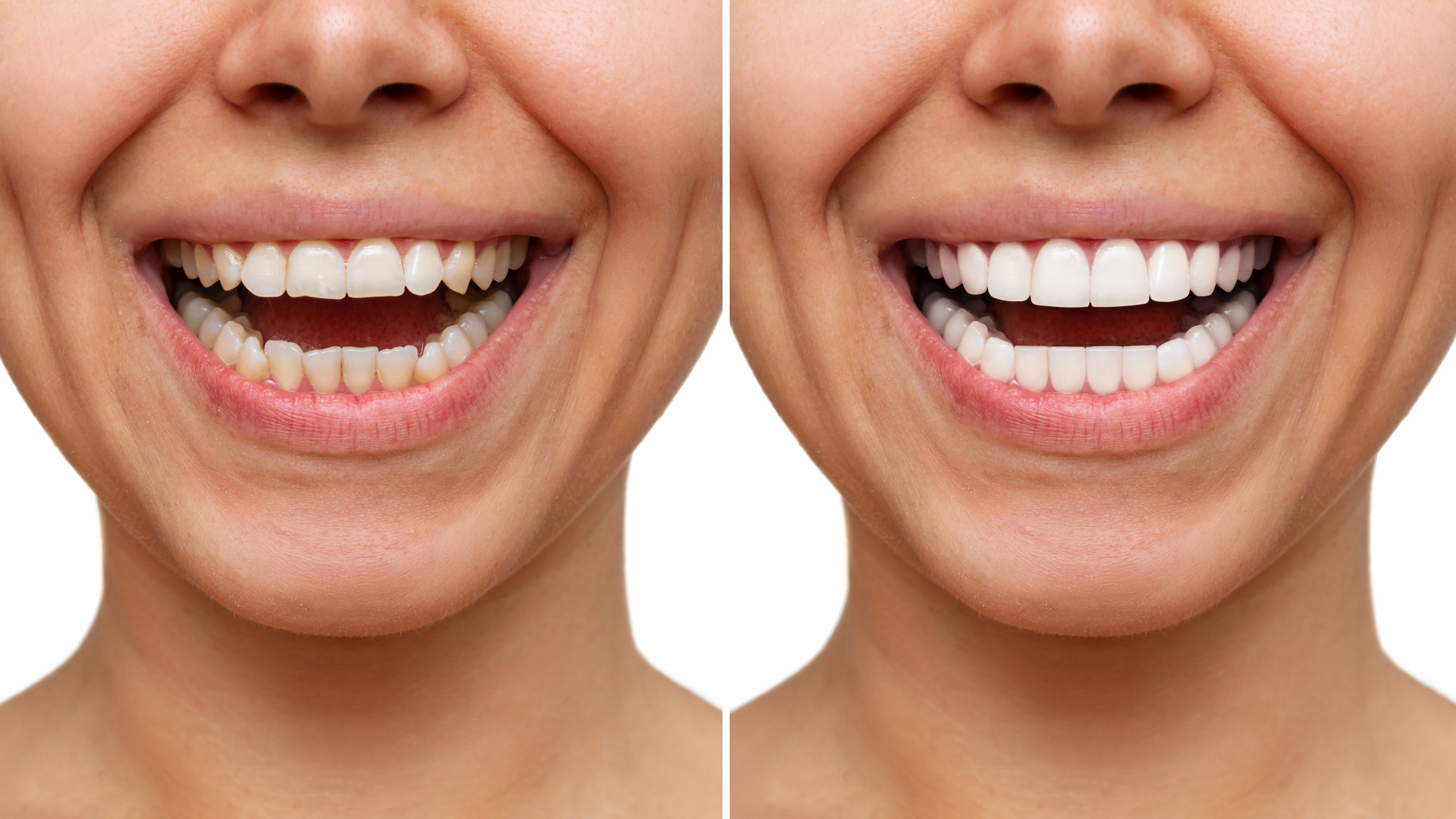 Beautiful smile transformation