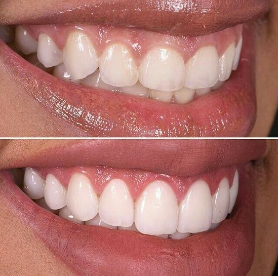 Gum Contouring
