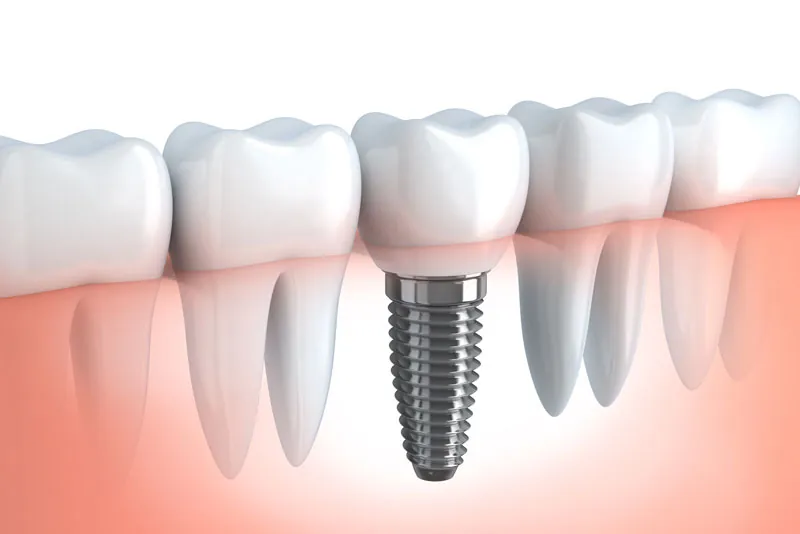 Dental implant restoration