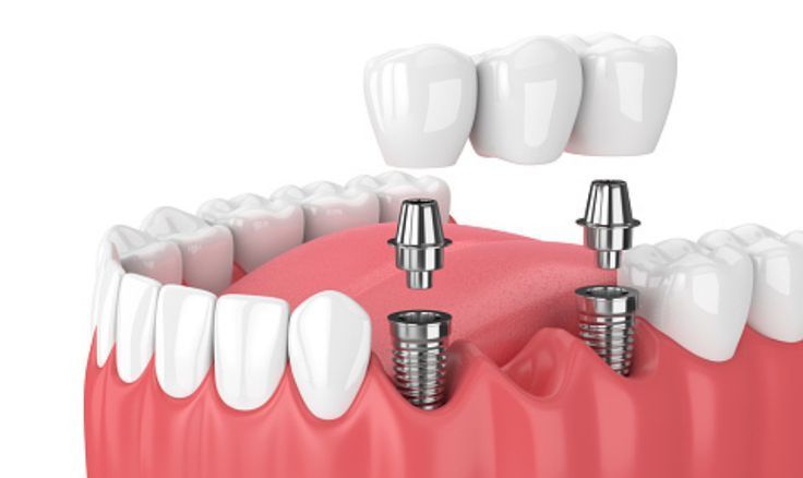 Implant-Supported Bridge