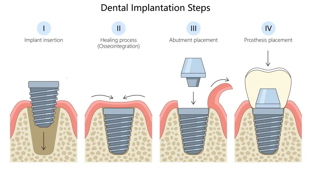 Dental implant procedure