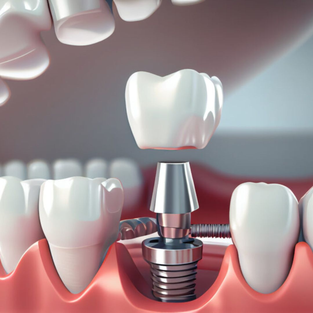Single Tooth Implant