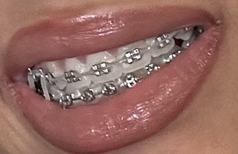 Traditional Metal Braces