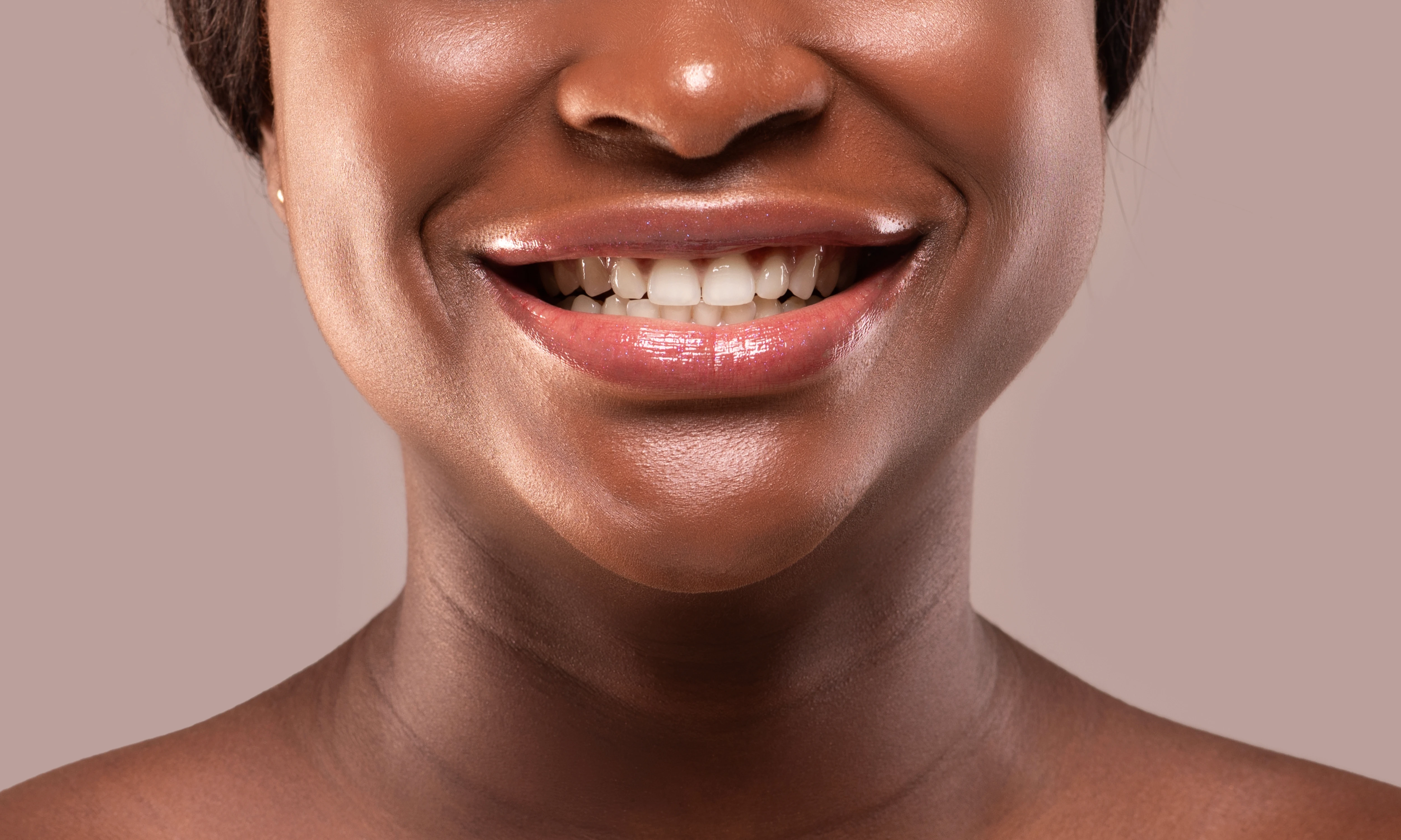 Porcelain Veneers