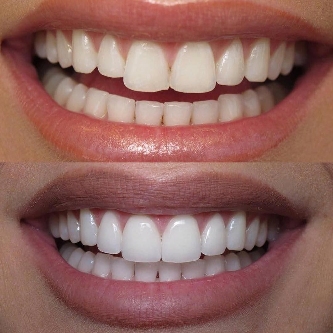 Teeth Whitening